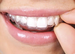 Invisible teeth braces