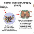 Spinal Muscular Atrophy (SMA) Therapeutics – Pipeline Analysis-ec6bc3d4
