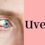 Uveitis Treatment