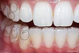 implantes dentales precios-8a0931c5