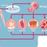 stem cell transplant