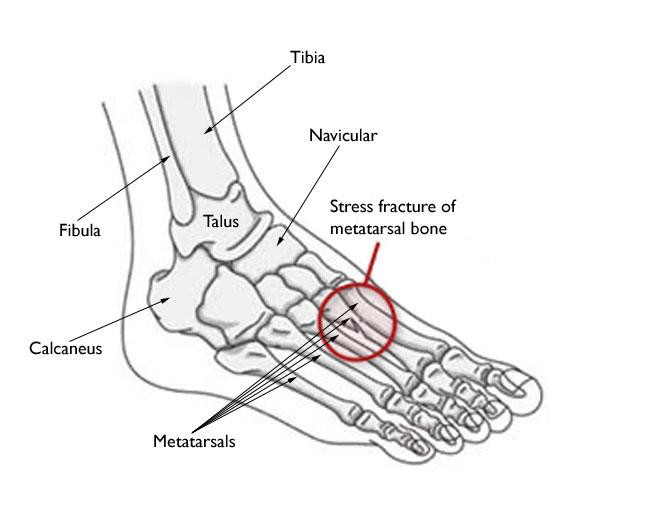 stress-fractures-the-physio-care-7151f5d8