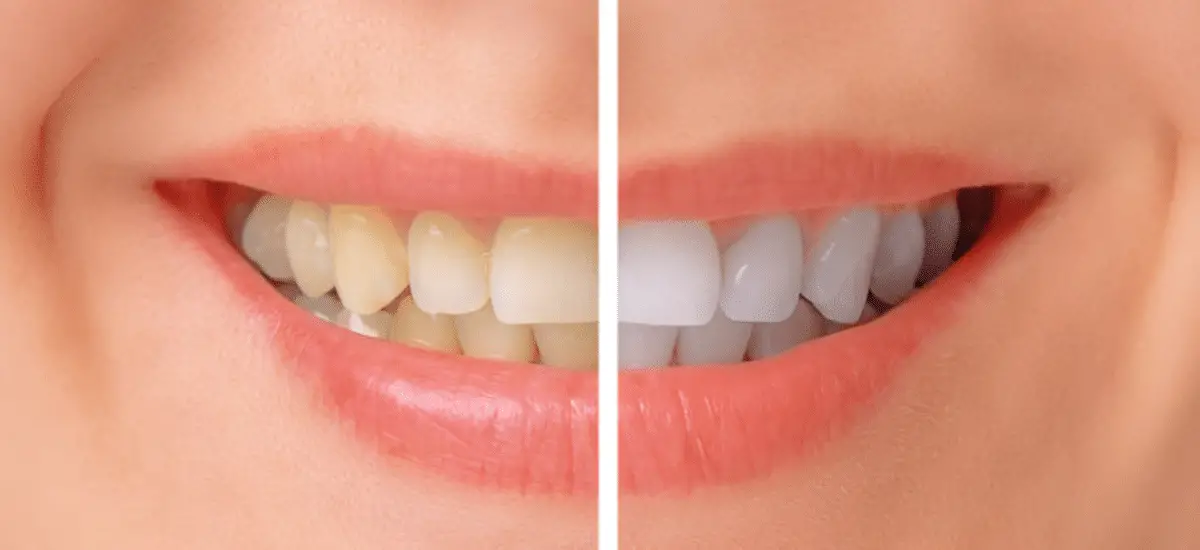 Teeth-Whitening-slider-219ee9dc