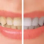 Teeth-Whitening-slider-ee787d74
