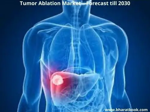Tumor Ablation-6e26e58a