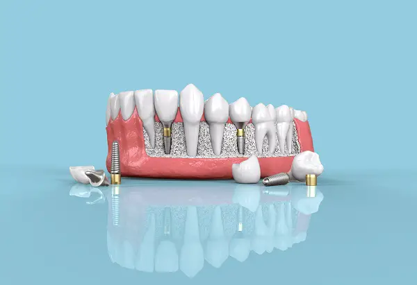 dental-implants-2108-5c25d3e2