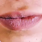 Lip Hyperpigmentation