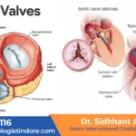Process of TAVI By dr siddhant jain-ee7d5042