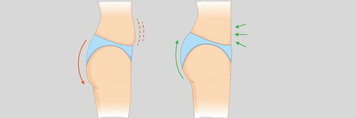 brazilian-butt-lift-surgery-5a3cdf5b