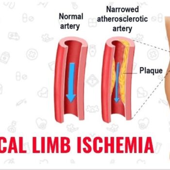 chronic-limb-ischemia-3601adba