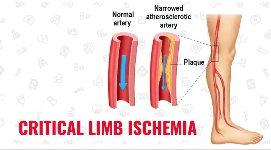 chronic-limb-ischemia-3601adba