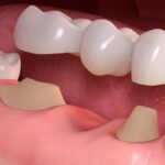 dental implants benton-54065f5b