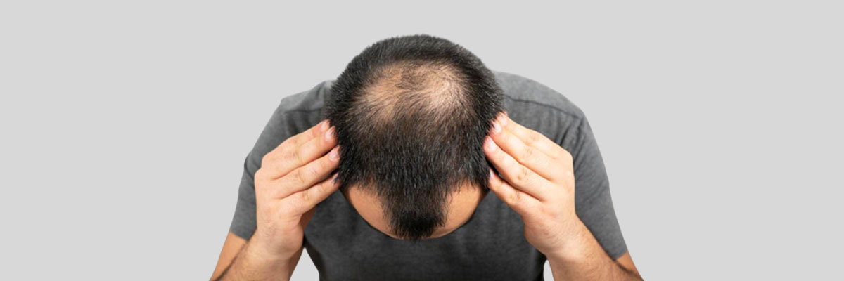 hair-transplant-e2074887