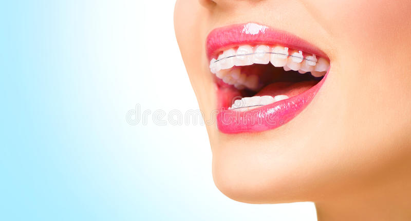 woman-smiling-ceramic-braces-teeth-beautiful-closeup-54501557-5635793a