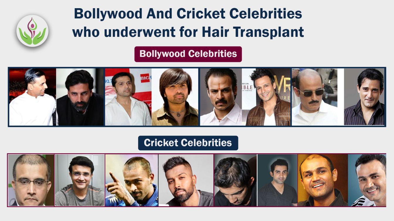 Bollywood And Cricket Celebrities who underwent Hair Transplant-2c094cfb