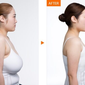Breast-Reduction-Cost-in-India-ed950cb6