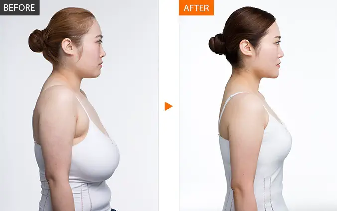 Breast-Reduction-Cost-in-India-ed950cb6