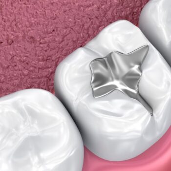 How can dental sealants protect your teeth from decay-7511e416