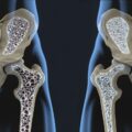 Osteoporosis Drugs-063babd4
