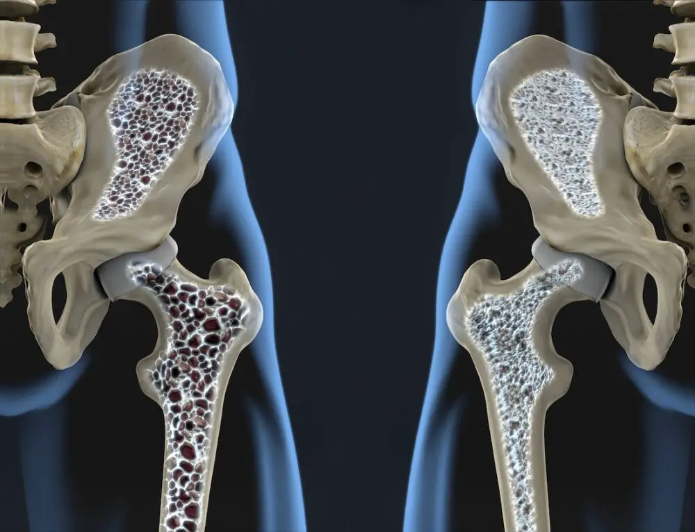Osteoporosis Drugs-063babd4