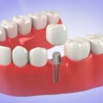 dental-implants-65246314