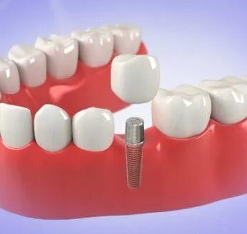 dental-implants-65246314