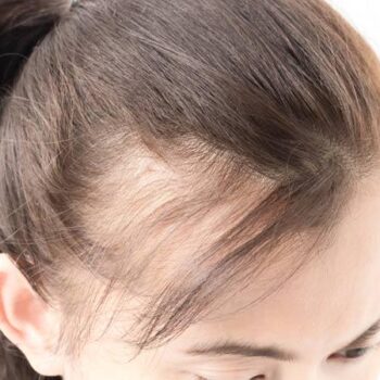 femalep-pattern-baldness-81fd302c