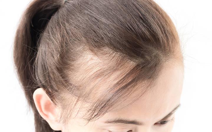 femalep-pattern-baldness-81fd302c