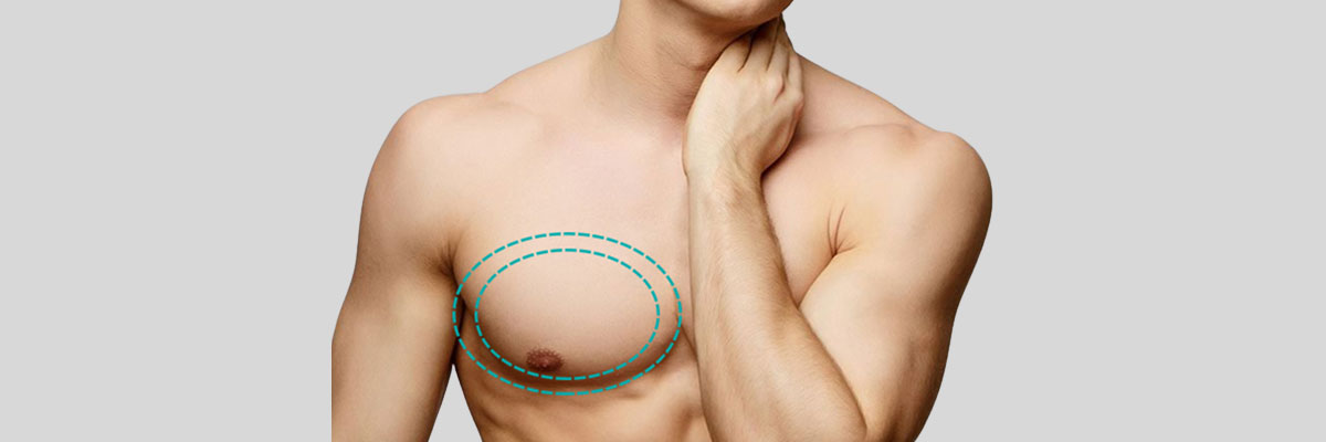 gynecomastia-male-breast-reduction-77dadf51