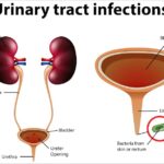 informative-illustration-urinary-tract-infections