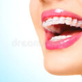 woman-smiling-ceramic-braces-teeth-beautiful-closeup-54501557-84feae6e