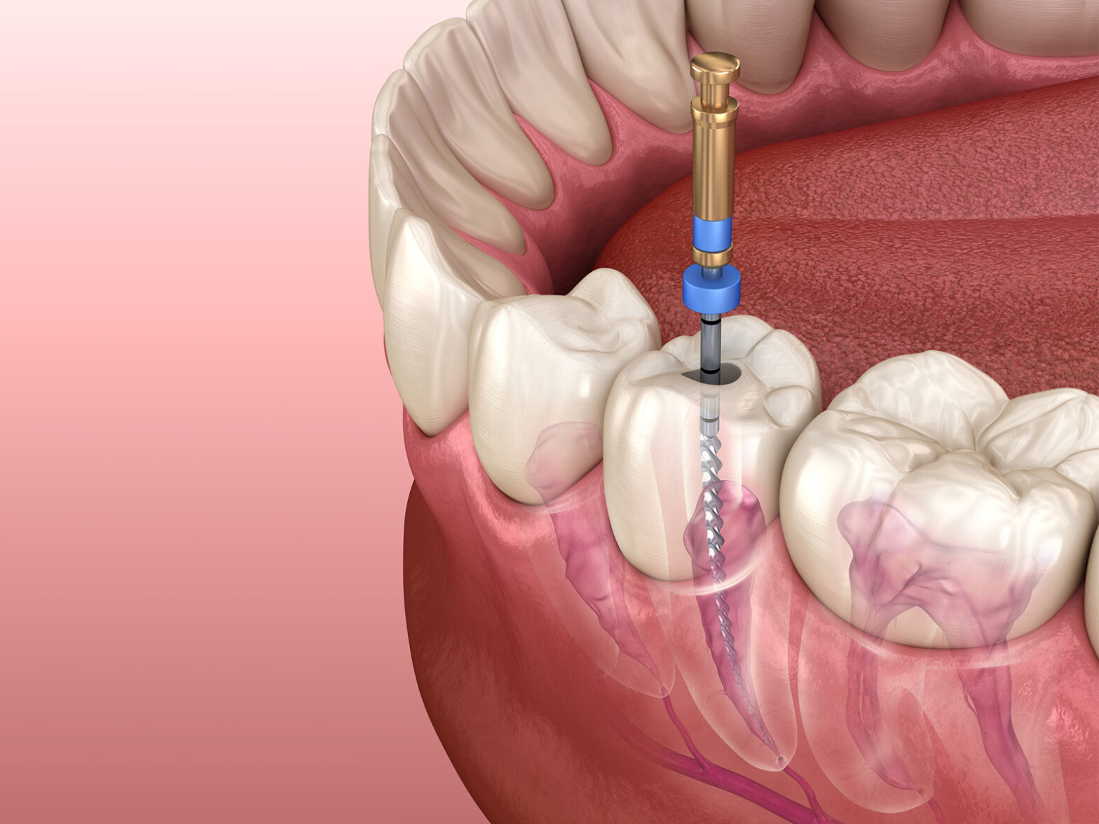 Advantages and Disadvantages of Root Canals-36a65f98