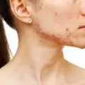TEENAGE ACNE CAN SCAR YOUR FACE-d5106600