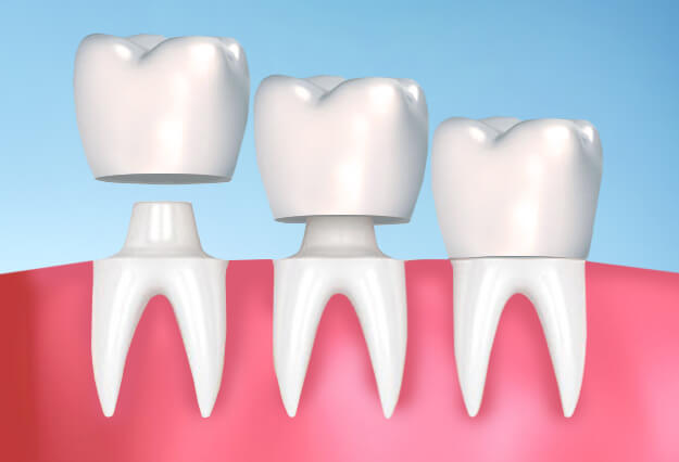 What Are Some Prudent Advantages of Porcelain Crowns-047690fe