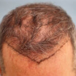 What-are-the-Different-Types-of-FUE-Hair-Transplants-Dr-Lokesh-Handa-Best-Plastic-Surgeon-in-Delhi-Med-Esthetiks-011-0664d7cf