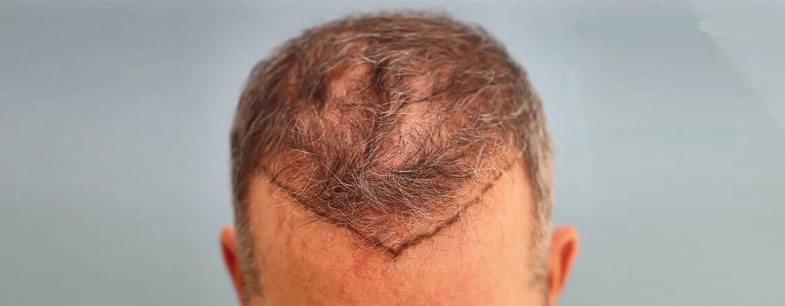 What-are-the-Different-Types-of-FUE-Hair-Transplants-Dr-Lokesh-Handa-Best-Plastic-Surgeon-in-Delhi-Med-Esthetiks-011-0664d7cf