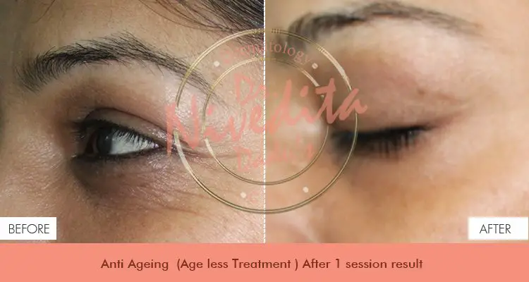 before-after-anti-aging-020618-5c60062d