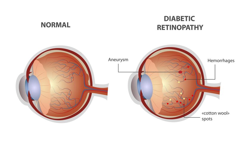 diabetic-retinopathy-eye