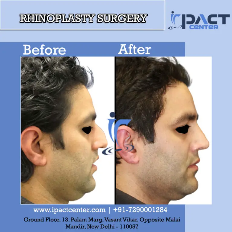 rhinoplasty surgery in Delhi