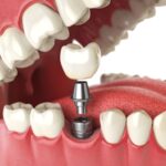Affordable dental implant-a45f96d2