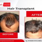 hair transplant in Kolkata