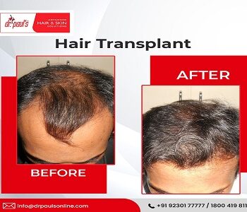 hair transplant in Kolkata