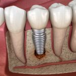 single tooth implant crawfordville fl-dbdcc671