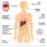 Crohn's Disease-3cc0e97d