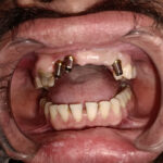 dental-implant-in-kolkata-f5c5986a