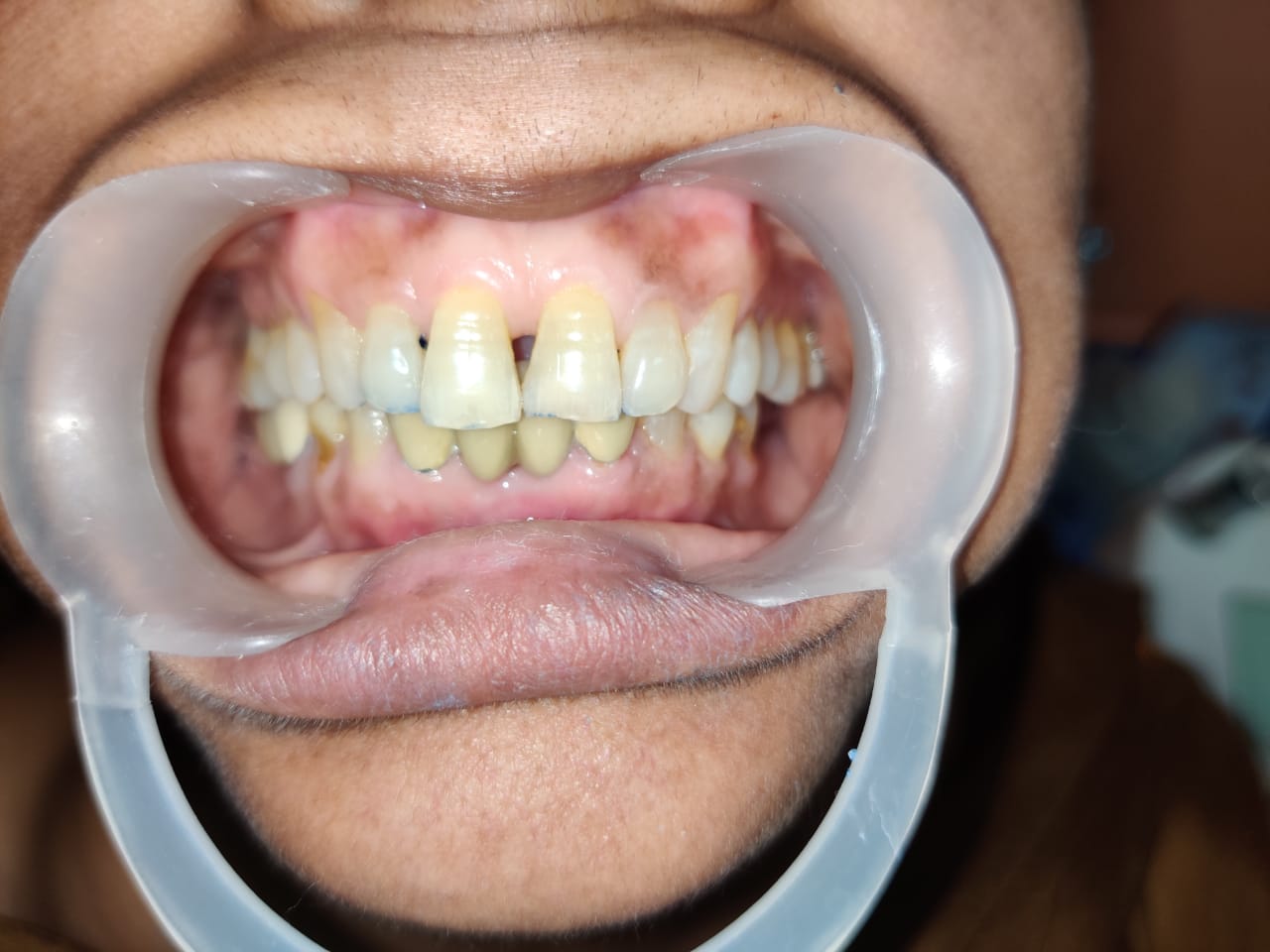 teeth-replacement2-48ccaec8