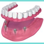 All-On-4-Dental-Implant-bc611c05