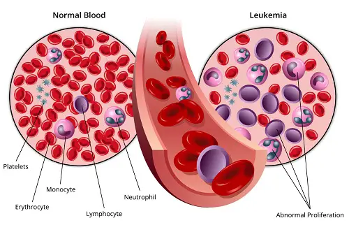 Chronic Lymphocytic Leukemia Therapeutics Market-491e405f