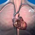 Implantable Cardiac Pacemaker-b6ac3892