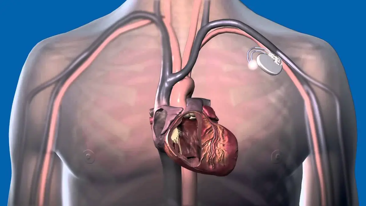 Implantable Cardiac Pacemaker-b6ac3892